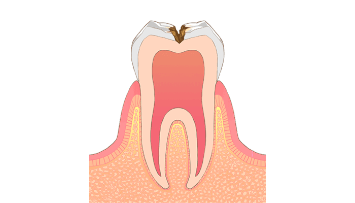 C2：冷たい物がしみる・痛みを感じる虫歯