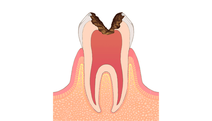 C3：神経まで進行し、激しい痛みを感じる大きな虫歯