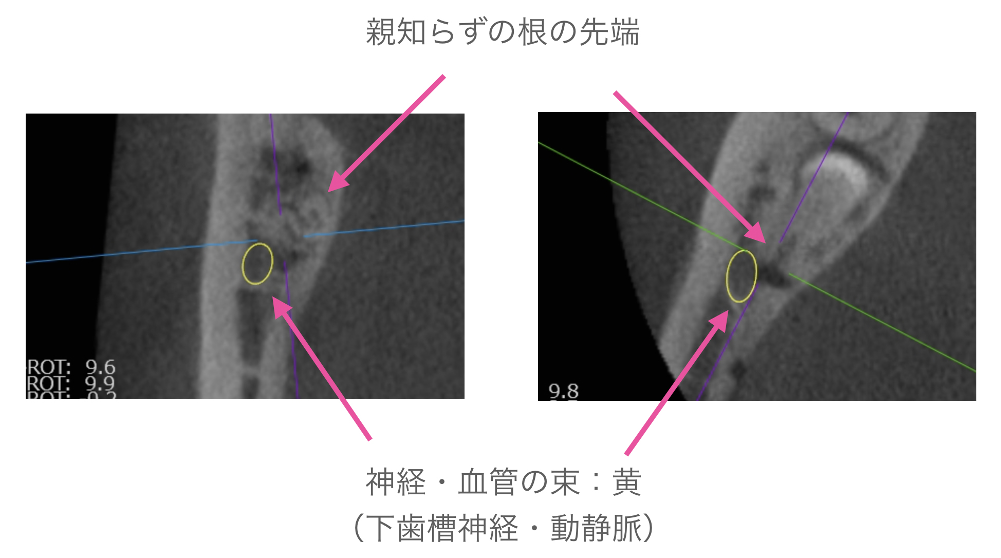 親知らずの根の先端