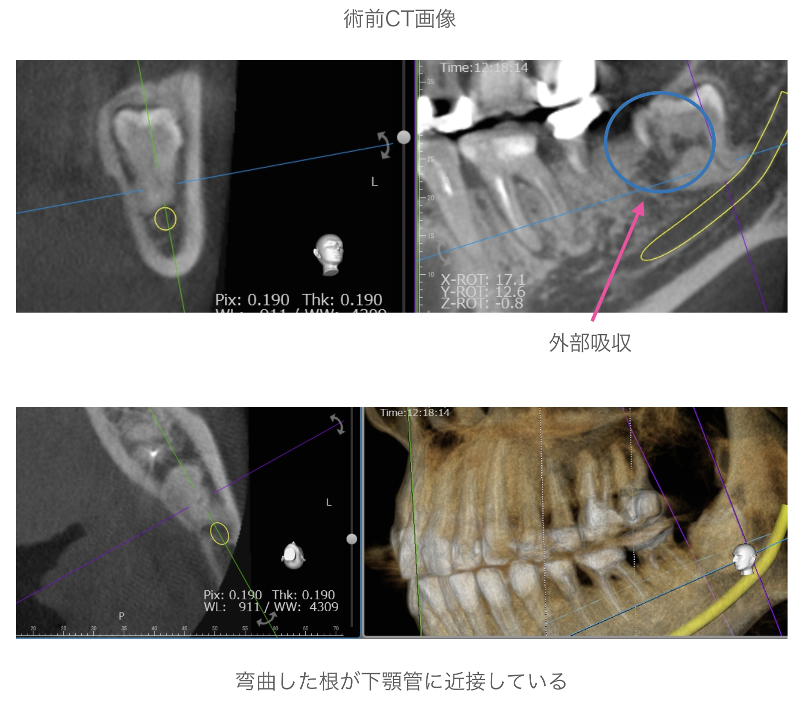 術前CT画像