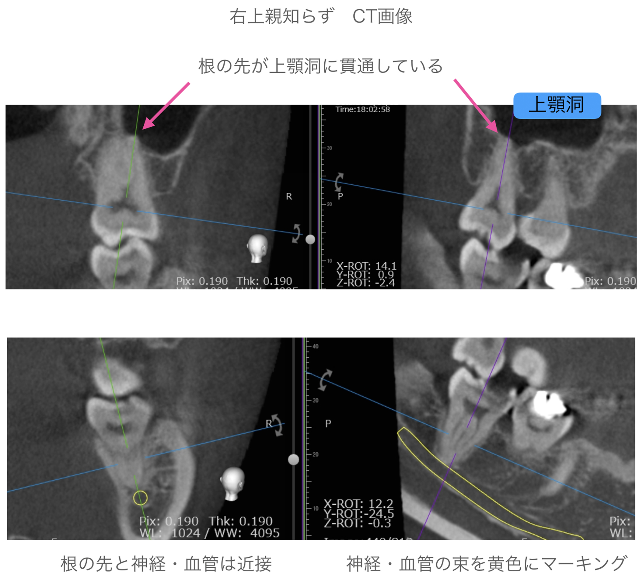 右上親知らず　CT画像