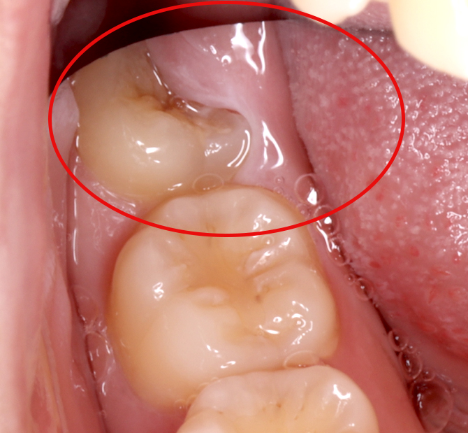 歯の半分が歯茎に覆われている状態